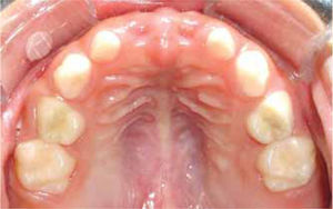 Oclusal superior. Dentición temporal libre de caries y ausencia de diente 51 y 61.