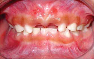 Vista anterior. Cicatrices de fístula en encía insertada a nivel de dientes 51 y 61.