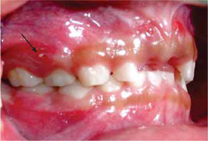 Lateral derecha. Fístula a nivel de órgano dentario 54 (flecha).