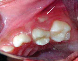 Lateral izquierda. Fístula a nivel de diente 64 (flecha blanca) y ausencia de caries (flecha negra).