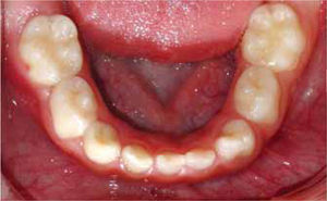Oclusal inferior. Dentición temporal libre de caries. Fusión de diente 72 y 73.