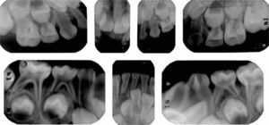 Radiografías dentoalveolares en donde se observa la amplitud de las cámaras pulpares y cuernos que se extienden hasta la unión amelodentinaria. Fusión de dientes 72 y 73.