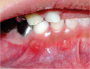 Absceso periapical en dientes 82 y 83.