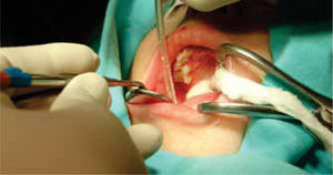 Se realizó la rehabilitación bucal sin dique debido a la falta de erupción de los molares temporales.