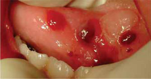 En el postoperatorio se observaron vesículas, úlceras y una zona depapilada.