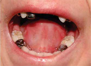 En el control a 15 días, se observó una mejoría de las lesiones en boca con un buen control de higiene.