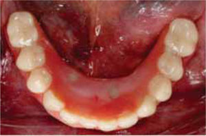 Prótesis protocolo inferior colocada. Visión oclusal y vestibular.