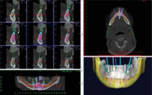 Planeación virtual definiendo el número y tamaño de los implantes.