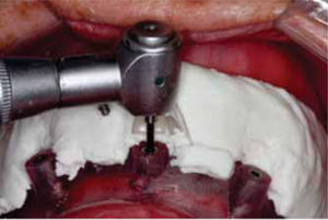 Perforaciones realizadas para fijación en la guía.