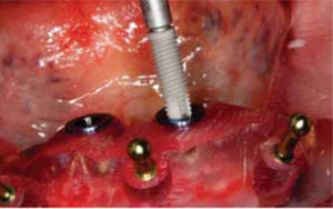 Instalación de implantes (Titamax Cone Morse, Neodent, Brasil) por los arillos de la guía.