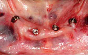 Minipilares cónicos (Neodent, Brasil) instalados sobre los implantes. Observe cómo después de la cirugía no existen colgajos quirúrgicos o suturas.