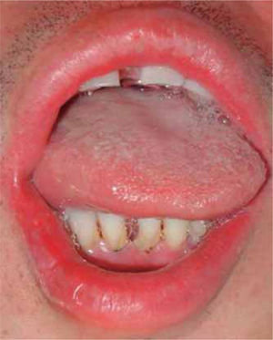 Apertura mandibular recuperada inmediatamente al reducir y fijar la fosa glenoidea.