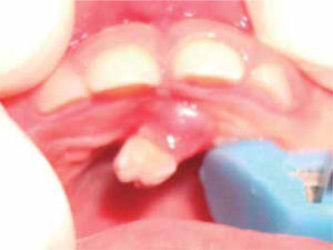 Aspecto clínico 15 días después de la extracción del diente supernumerario del lado derecho.