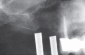 Radiografía inicial con guía quirúrgica.