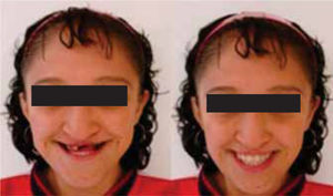Seguimiento de la paciente a un año, aspecto sin prótesis (izquierda), aspecto con prótesis (derecha).