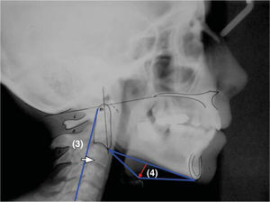 (3) Curvatura cervical. Distancia en milímetros que va desde el punto central del plano que pasa por el punto más superior de la odontoides hasta el más inferior de la quinta vértebra cervical, hasta la tercera vértebra cervical. (4) Triángulo hioideo. Distancia perpendicular que va del plano C3 a RGn a la parte más superior del hioides. La posición vertical normal del hioides es cuando se encuentra entre C3 y C4.