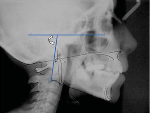 Ángulo cráneo cervical. Ángulo posterior formado por Frankfort y una línea tangente a la parte posterior de la odontoides. Este ángulo nos indica la posición de la odontoides respecto a las estructuras craneales.