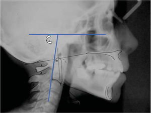 Inclinación cráneo cervical. Ángulo posterior formado por Frankfort y un plano que pasa desde C4 hasta la parte posterosuperior de la odontoides. Nos indica la inclinación de la columna cervical respecto a las estructuras craneales.