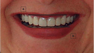 Análisis de la sonrisa. Sonrisa media que muestra la longitud total cérvico incisal de dientes anteriores y zona de papilas. a) línea gingival, b) plano incisal.