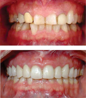 Análisis comparativo intraoral. Al inicio del tratamiento y a los 22 meses, obteniendo una adecuada unidad protésico periodontal.