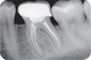 Radiografía de mantenimiento a los cinco años. Se observa el diente coronado, así como estado normal del tejido perirradicular.