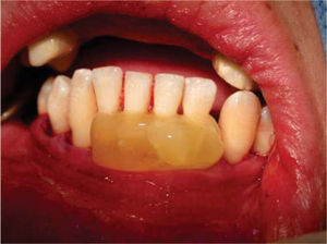 Aplicación del PRFC en los dientes inferiores.