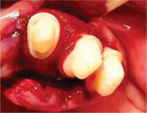 Colocación de la membrana y autoinjerto en el diente 23, 24 y 25.