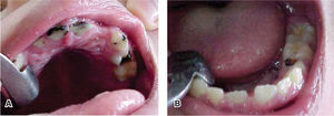 A. Exploración de la cavidad bucal. Procesos cariosos grado 2 y 3, ausencia congénita del órgano dentario 62. B. Presencia de múltiples procesos cariosos grado 2 y 3.