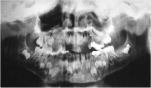Evaluación radiográfica. Ausencia congénita del órgano dentario 62. Presencia de todos los gérmenes permanentes.