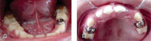 A. Rehabilitación bucal inferior. B. Rehabilitación bucal superior
