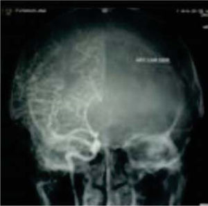 Los vasos normales de la base del cráneo y de sus zonas vecinas suelen estar desplazados por el tumor.