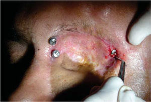 Debridación del tejido excesivo que rodeaba y cubría el implante.