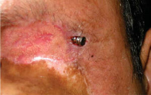 Pin de impresión colocado como medio retentivo de la prótesis en lugar de utilizarse el implante directamente, dado que el tejido circunscrito lo cubría.