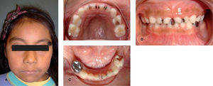 Caso 1. A) Paciente de 7 años 1 mes, fotografía frontal, B) fotografía oclusal superior, en donde se observa dentición temporal, C) fotografía oclusal inferior, observamos ausencia de los órganos dentarios 75 y 85, D) fotografía en máxima intercuspidación.
