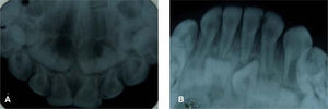 Radiografías del caso 2. A) Oclusal superior, B) oclusal inferior.