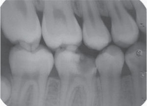 Imagen radiográfica que muestra la ausencia de afección del hueso subyacente.