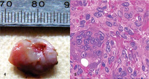 Aspecto macroscópico e histológico de la lesión adonde se observa la proliferación de células gigantes con pigmentación de hemosiderina en macrófagos y estroma fibroso (HE x250).