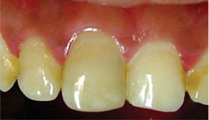 Control a los tres meses; se observa un tono similar a los dientes adyacentes.