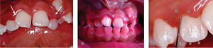 A) Estado periodontal del paciente al inicio del tratamiento. Gingivitis marginal en 12 y 22. B) Marzo de 2004: primer control personal de placa dentobacteriana. C) Marzo de 2004: primer sondeo e índice periodontal (Löe y Silness modificado).