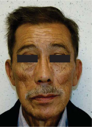 Vista facial frontal del paciente rehabilitado a dos años de seguimiento.
