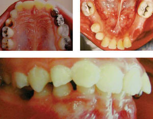 Características intraorales. Intraoralmente, los pacientes con X frágil se relacionan con alto índice de caries debido a un déficit de higiene, además de mal posición dental, debida a las anomalías craneoencefálicas que presenta.
