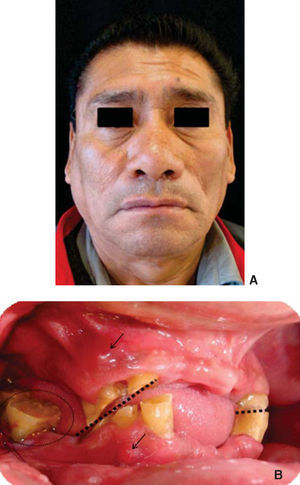 A) Fotografía frontal (obsérvese la asimetría facial del lado derecho) y B) Fotografía intraoral. Se identifica el plano oclusal irregular (líneas punteadas), las fístulas (flechas) y el sangrado debido a las condiciones periodontales (óvalo).