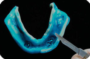 Recorte de la impresión fisiológica mandibular para emplearla como placa de registro de relaciones cráneo-mandibulares.