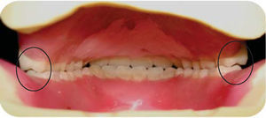 Vista posterior de la dentadura en cera. Obsérvese que únicamente contactan las cúspides palatinas (círculos).