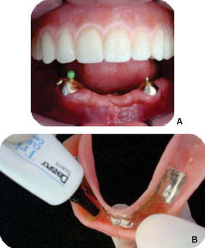Activación de aditamentos. A) Dentadura maxilar insertada y hembra de aditamento derecho colocada para su activación; B) Superficie intaglio de la dentadura mandibular.