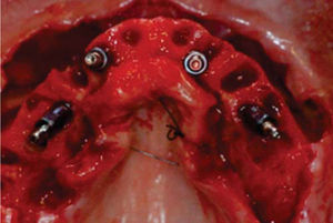 Vista oclusal de los implantes mostrando la inclinación de los dos más distales.