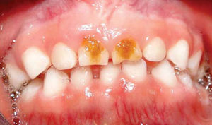 Órganos dentarios afectados.