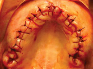 Sutura de mucosa alveolar.