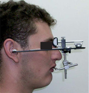 Registro del arco facial.