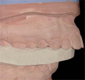 Guías de yeso para el montaje del modelo inferior con la técnica trazo de arco gótico: vista lateral